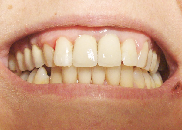 Prosthetiki dontiwn 3