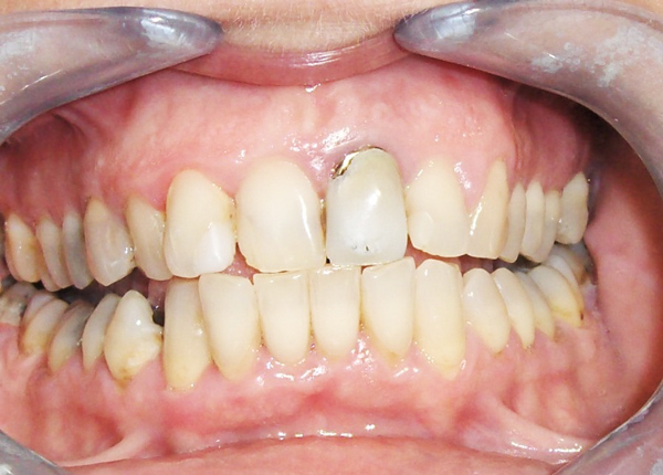 Prosthetiki dontiwn prin